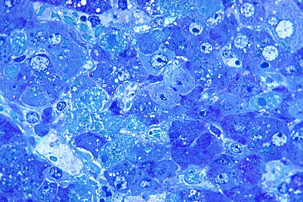 Lassa Fever