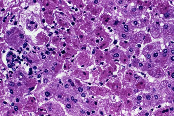 Marburg Virus Disease