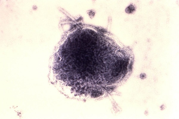 Measles