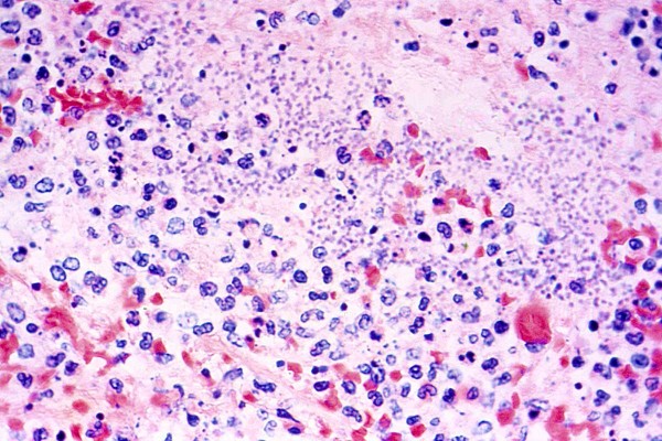 Plague