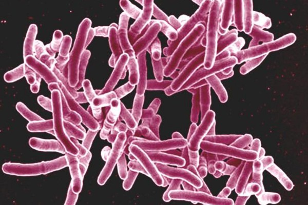 Tuberculosis